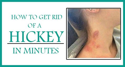 tit hickey|How To Get Rid of a Hickey: 5 Tricks To Try